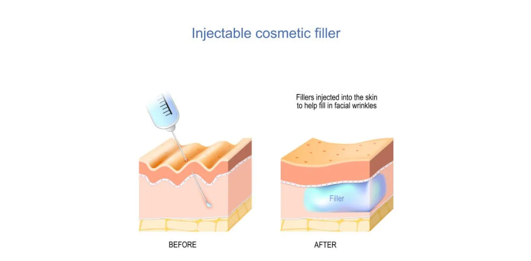 Price of Dermal Fillers Price of Dermal Fillers