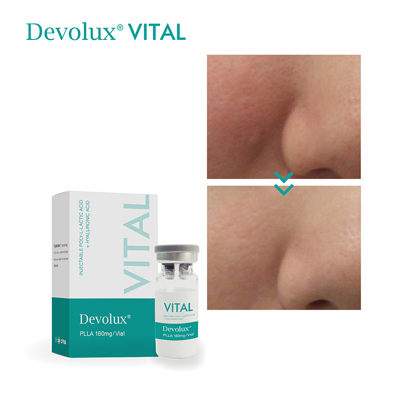 Devolux vital plla filler before and after Devolux vital plla filler before and after