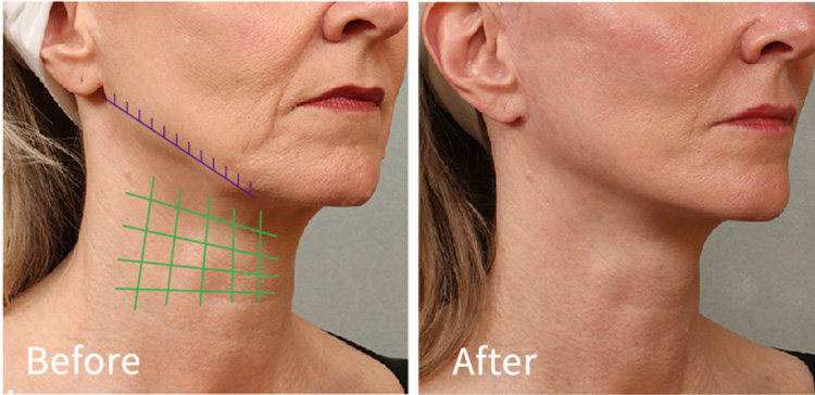 Pdo-Thread-Lift-Neck-Before-And-After Pdo-Thread-Lift-Neck-Before-And-After