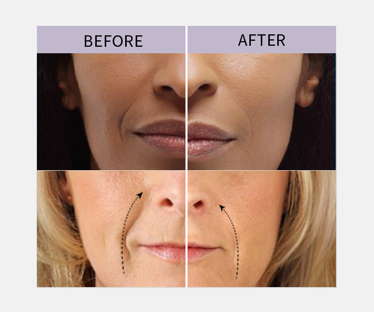 Wholesale-Hyaluronic-Acid-Filler_17 Wholesale-Hyaluronic-Acid-Filler_17