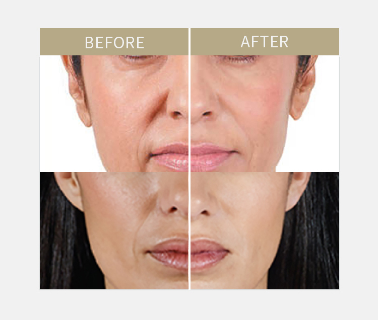 Aqua Secret Filler Light 1ml Dermal Filler Aqua Secret Filler Light 1ml Dermal Filler