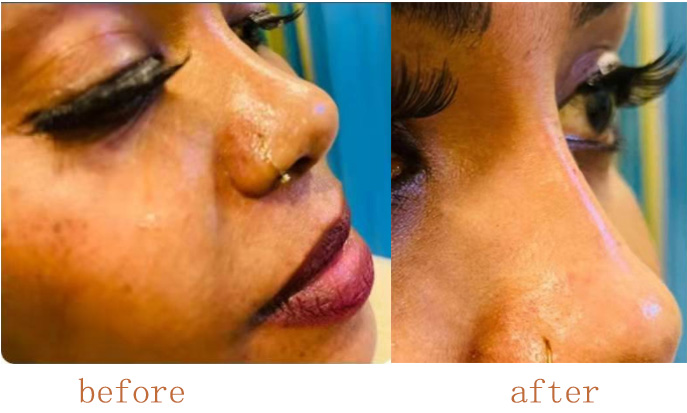 Pdo-Nose-Thread-Lift-Before-And-After Pdo-Nose-Thread-Lift-Before-And-After