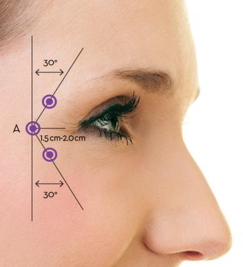 sotorior Crows feet injection pattern sotorior Crows feet injection pattern