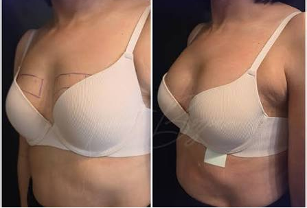 hyaluronic acid breast filler before and after 4 hyaluronic acid breast filler before and after 4