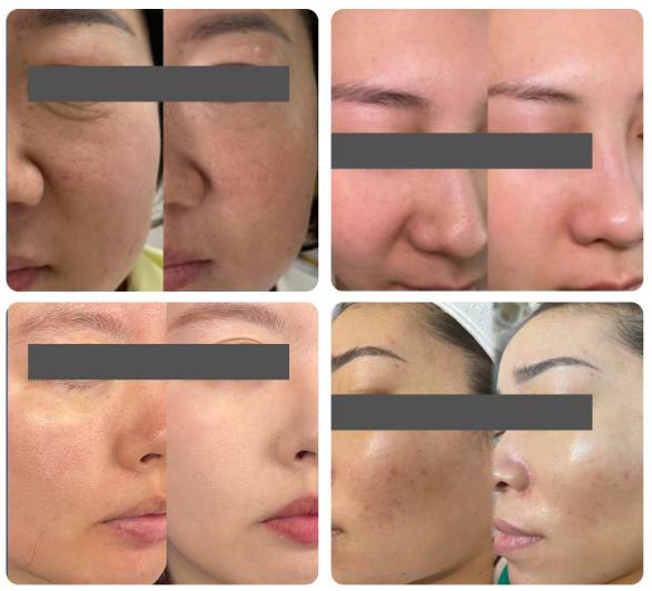 EXOBLOOM™ Exosome before and after EXOBLOOM™ Exosome before and after