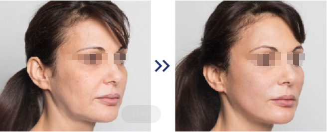 Pdo-Thread-Cheek-Lift-Before-And-After Pdo-Thread-Cheek-Lift-Before-And-After