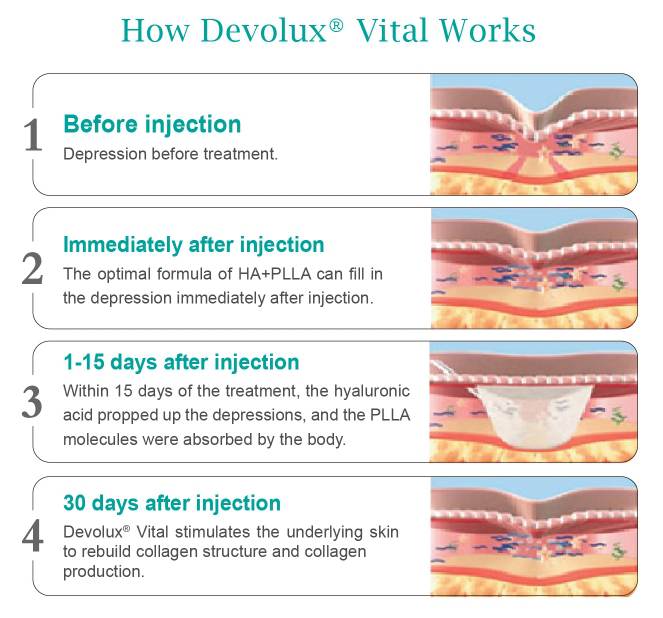 plla fillers (2) plla fillers (2)