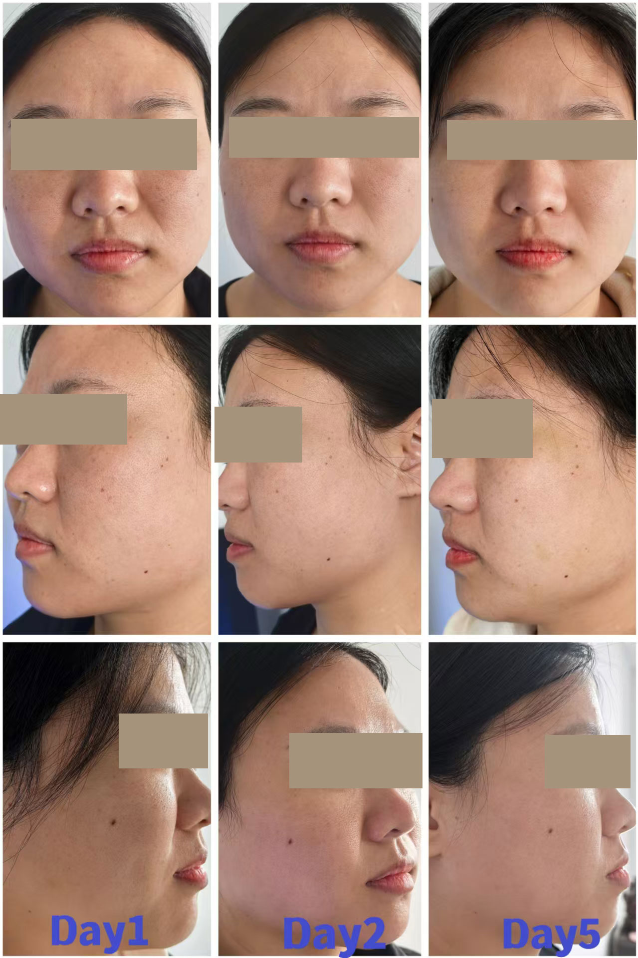 Mesocel PDRN serum BEFORE AND AFTER Mesocel PDRN serum BEFORE AND AFTER