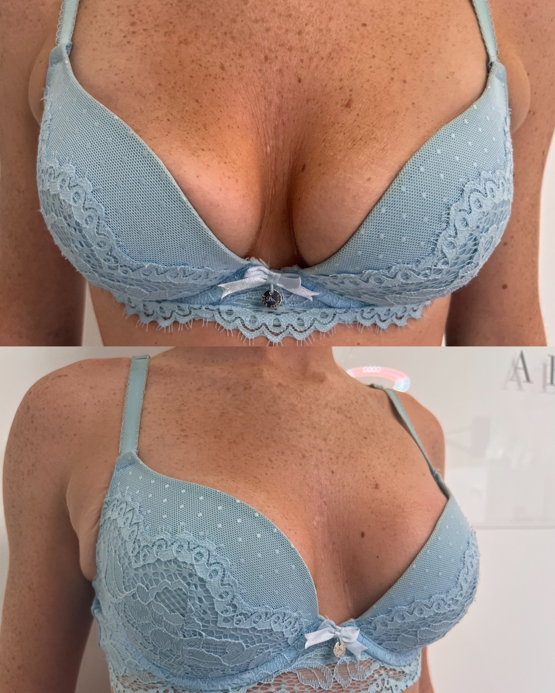 hyaluronic acid breast filler before and after 3 hyaluronic acid breast filler before and after 3