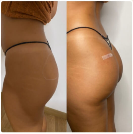 Macrolite Buttock Filler Before and After Transformations (3) Macrolite Buttock Filler Before and After Transformations (3)