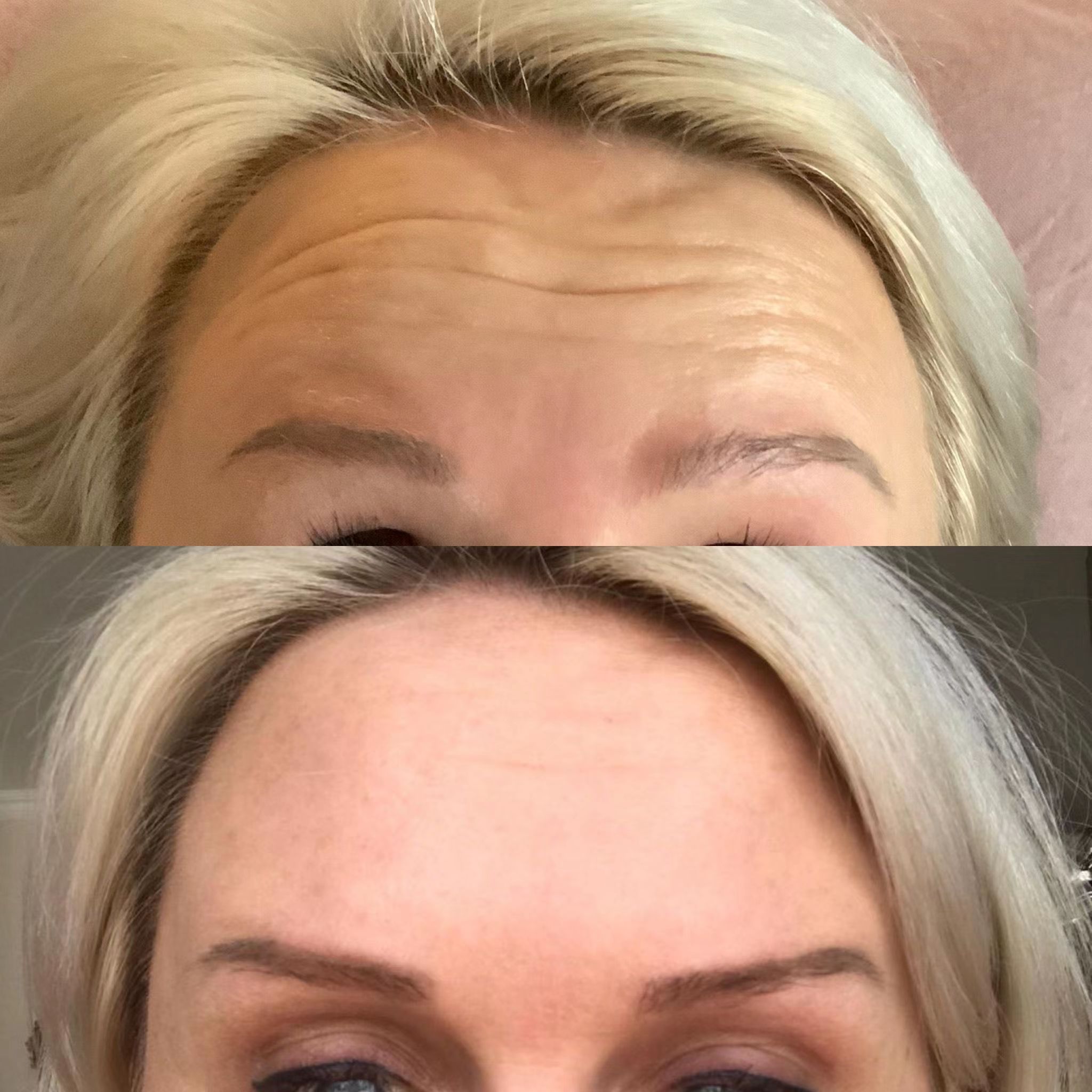 Botulinum Toxin Brow Lift Before and After Photos 1 Botulinum Toxin Brow Lift Before and After Photos 1