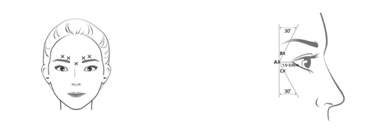 botulax injection glabellar lines botulax injection glabellar lines