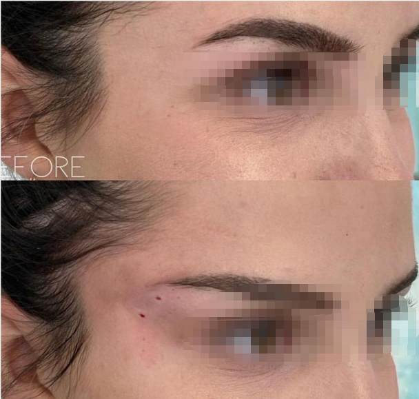 Fox-Eye-Pdo-Thread-Lift-Before-And-After Fox-Eye-Pdo-Thread-Lift-Before-And-After