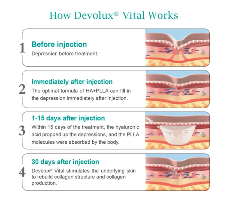 Reborn PLLA Treatment Timeline Reborn PLLA Treatment Timeline