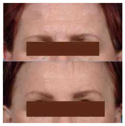 Botulinum Toxin Brow Lift Before and After Photos 3 Botulinum Toxin Brow Lift Before and After Photos 3