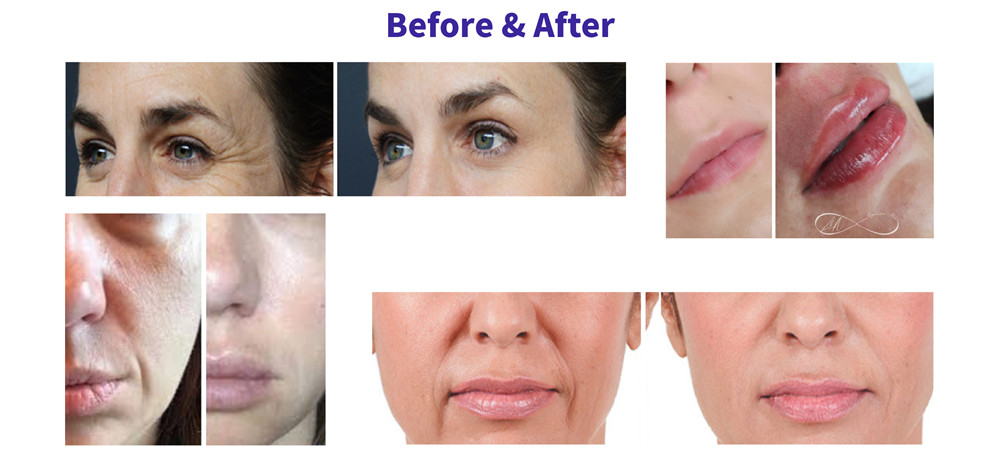 Aqua-Secret-Ha-Dermal-Filler-comparision Aqua-Secret-Ha-Dermal-Filler-comparision