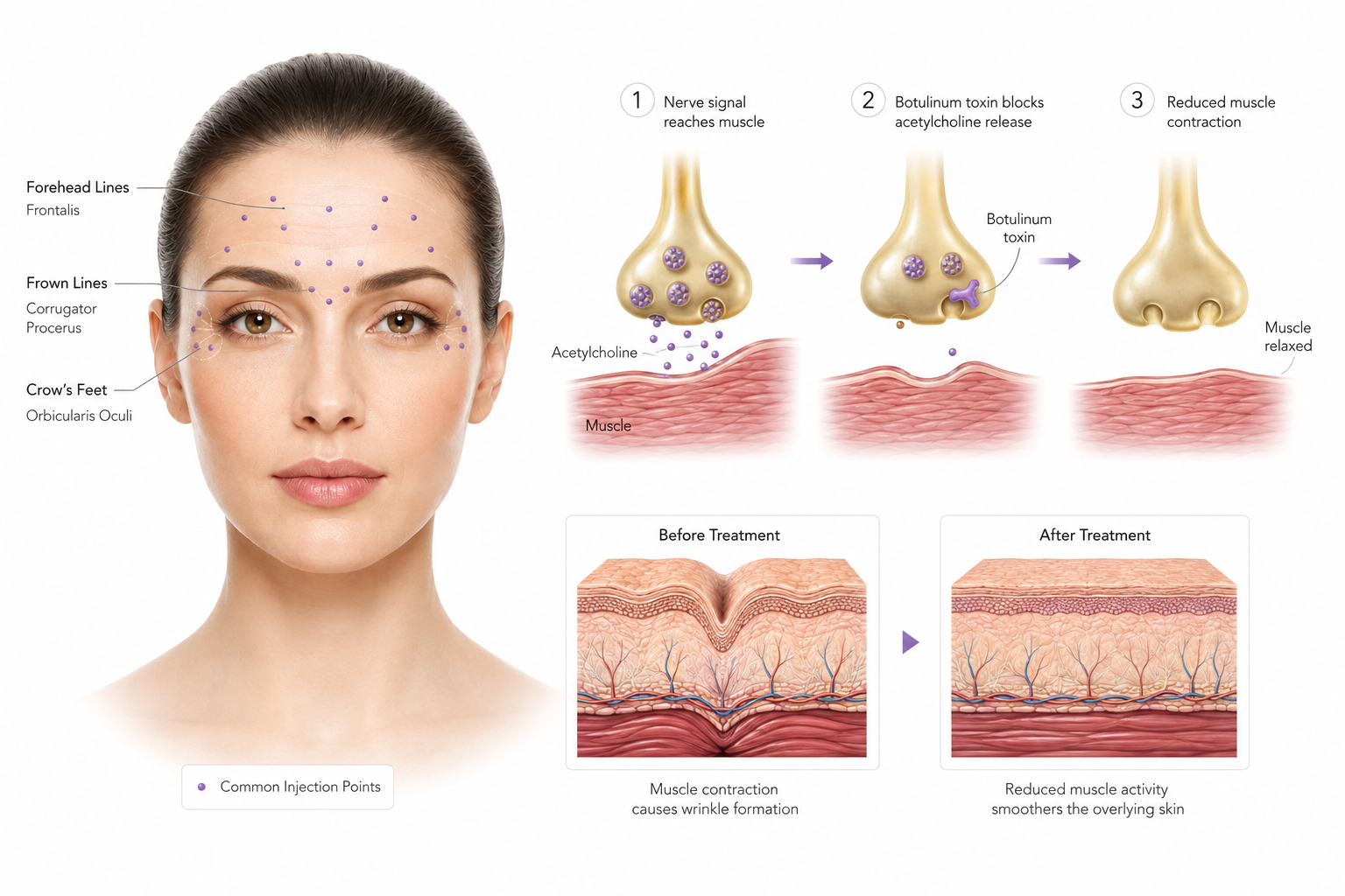 How Does Botulinum Toxin Reduce Facial Wrinkles? How Does Botulinum Toxin Reduce Facial Wrinkles?