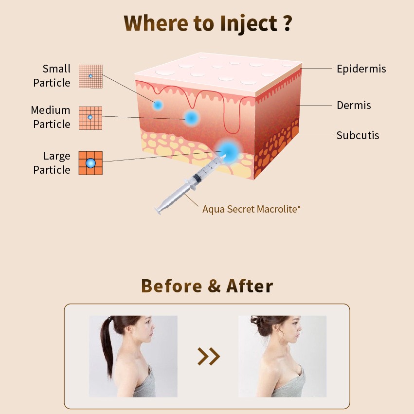 Medical beauty products for breast augmentation and buttock augmentation (5)