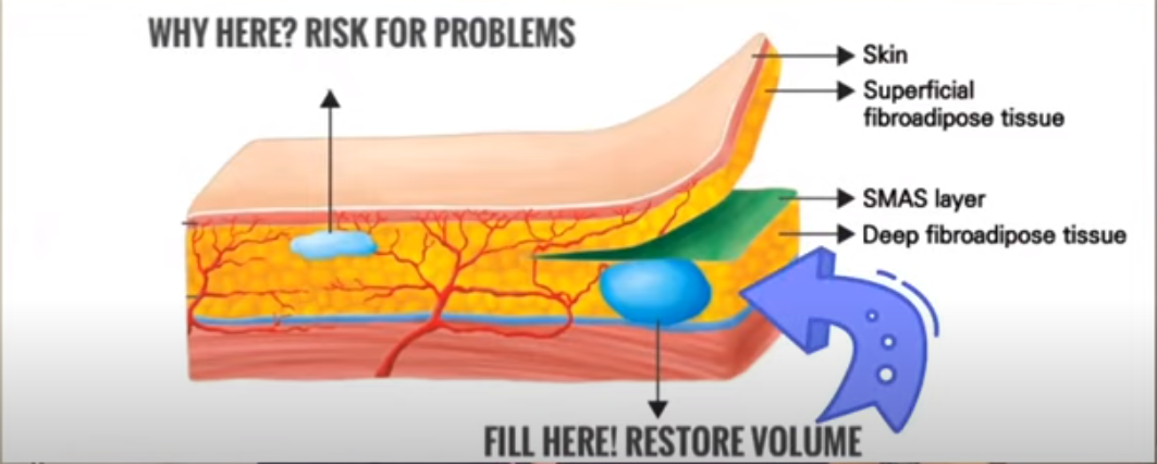 Why displaced or bruised after filling tear troughs 1