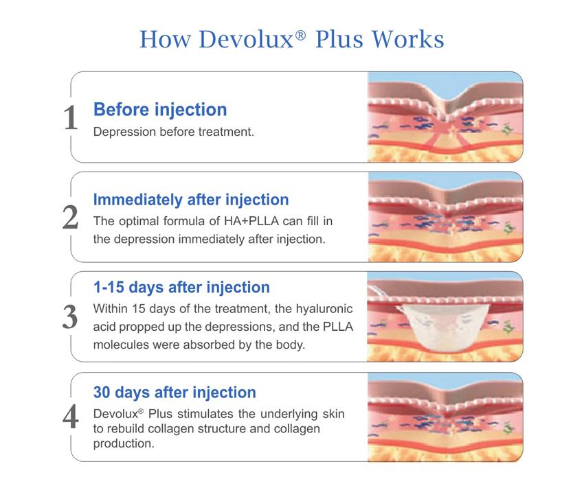 plla filler buttock injections