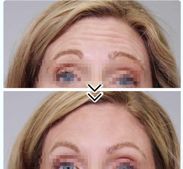 botulax before and after 2