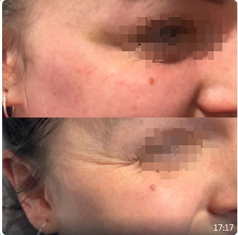 botulax botulinum toxin before and after 3