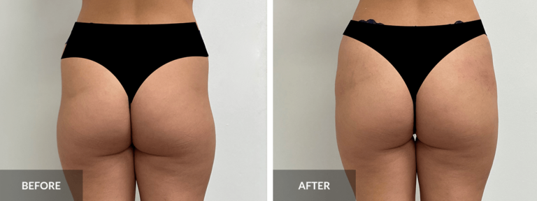 Charmacy CaHA Filler Butt Lift before and after