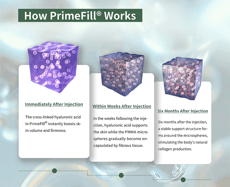 PrimeFill pmma filler syringe- Dermax