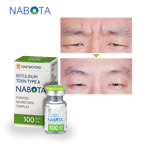 Nabota Botulinum Toxin Glabellar Injection Price.jpg