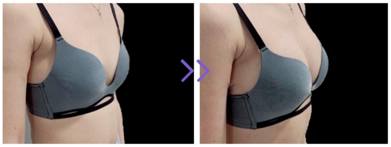 Devolux Breast Filler Injections Before and After