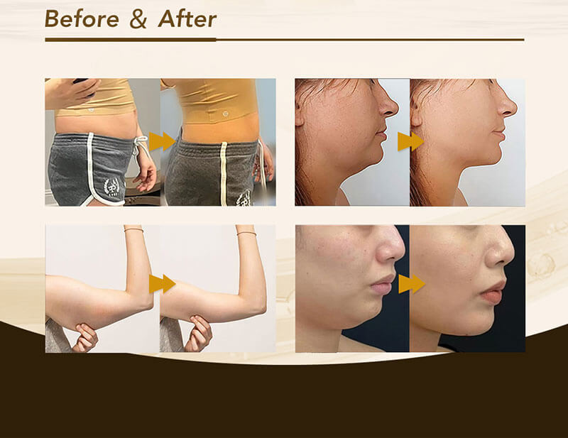 Before and After LipoGo™ Lipolytic Solution