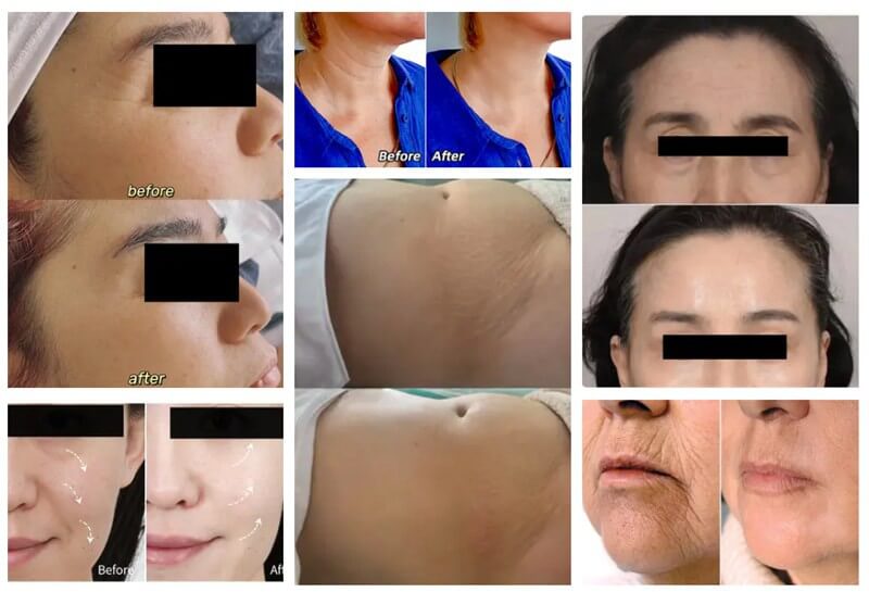Devolux Poly-L-Lactic Acid (PLLA) Filler before and after