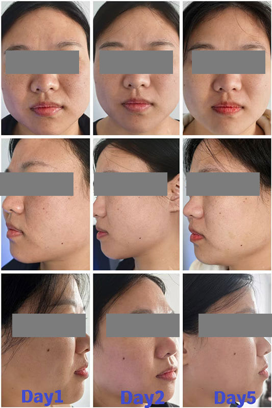 Mesocel&reg;-PDRN-Before-and-After-Dull,-Tired-Looking-Skin