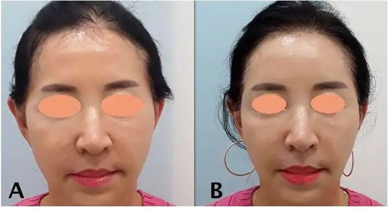 Plla injection before and after