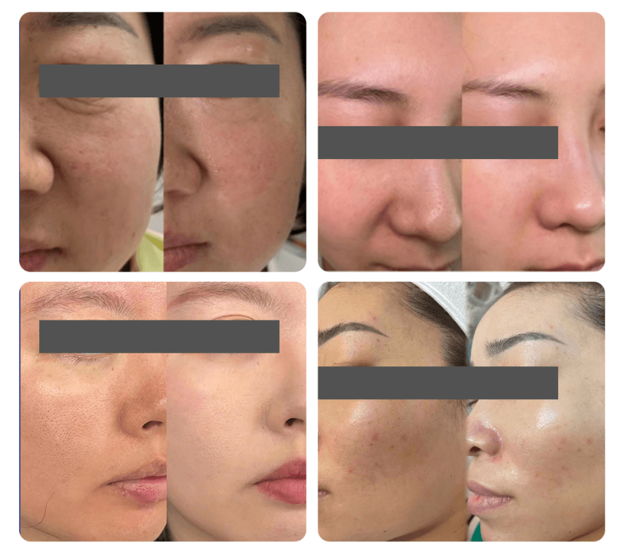 How Does Exosome Skincare Promote Skin Rejuvenation?