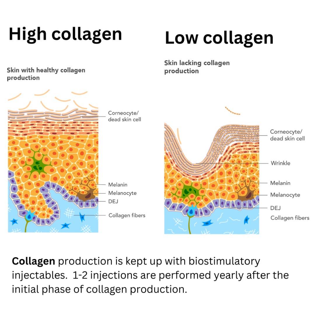 PLLA filler collagen stimulation process