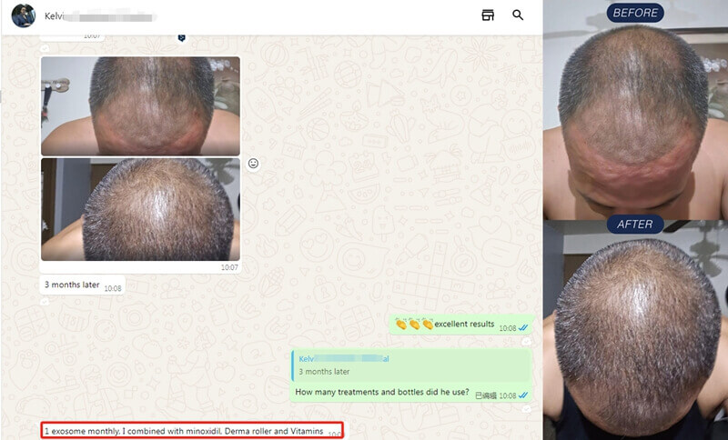 hair mesotherapy before and after