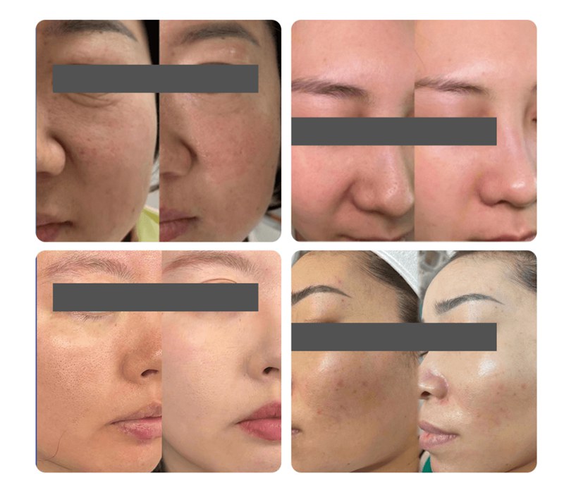 exosome skin booster before and after