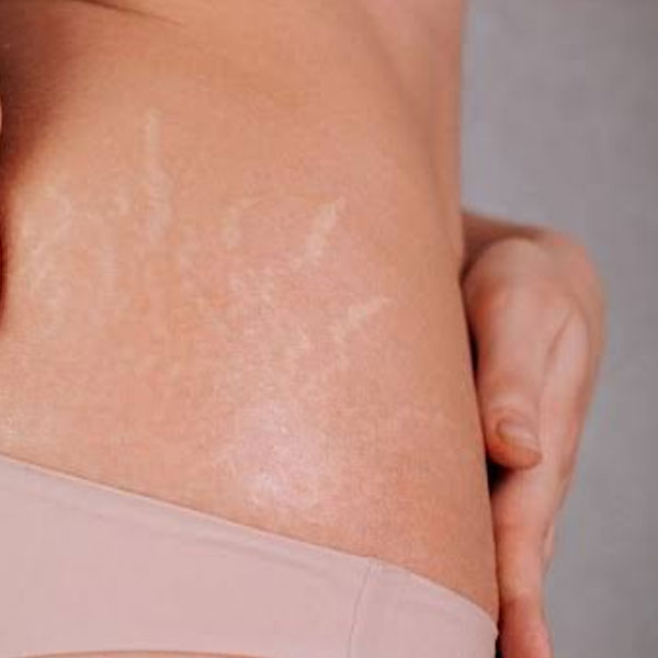 Can PLLA Improve Stretch Marks?