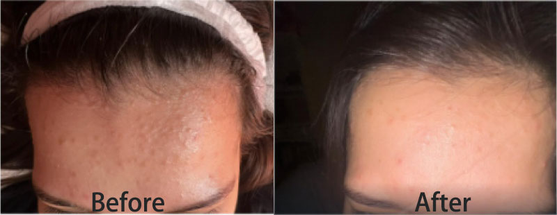 skin quality improvement after PDRN treatment