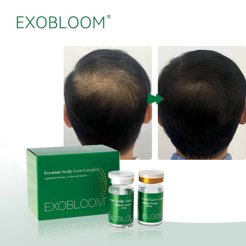EXOBLOOM&reg; Exosome Scalp Care