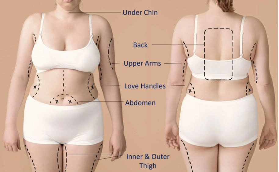 Fat Dissolving Injections Treatment Areas