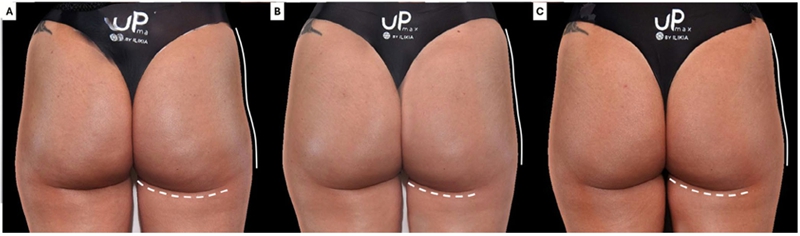 hyaluronic acid buttock augmentation