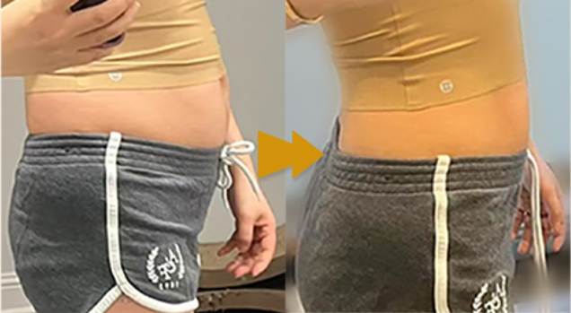 fat dissolving injections before and after (2)