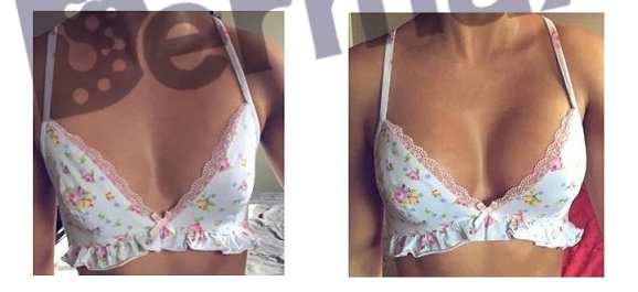 Hyaluronic Acid Breast Filler Before And After