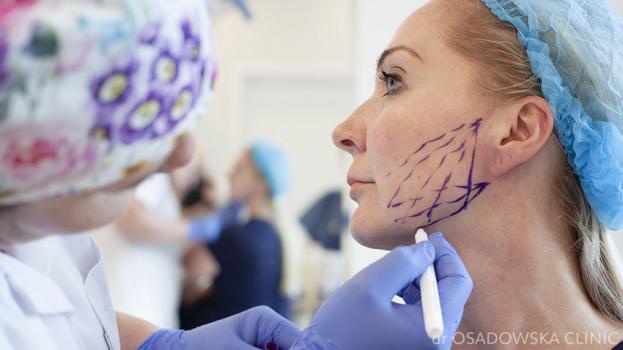 IS A PDO THREAD LIFT REALLY WORTH IT (2)