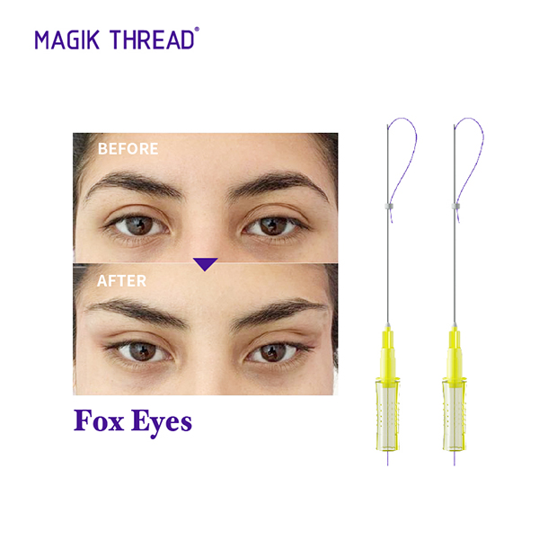 fox eye pdo thread lift