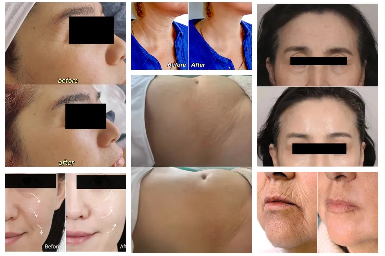 devolux Vital before and after