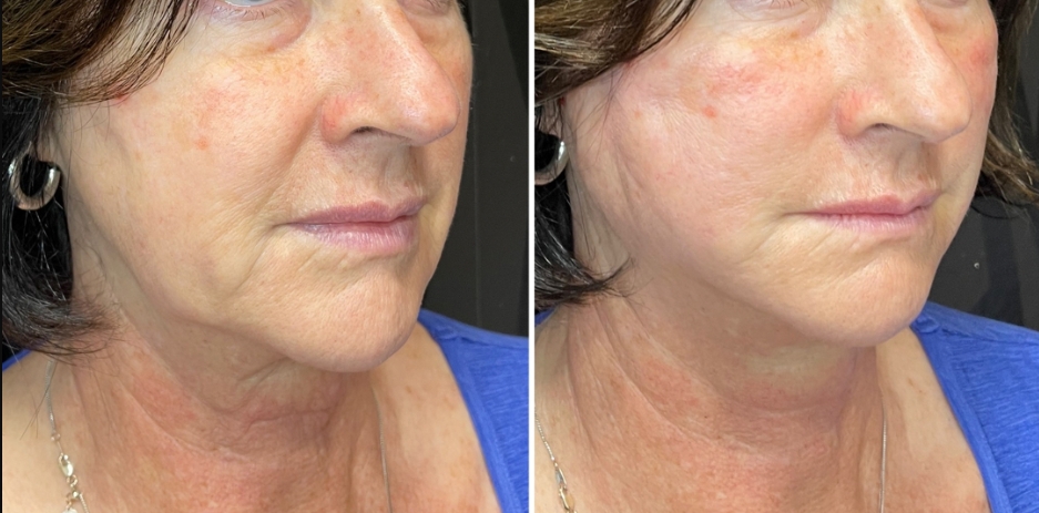 Jawline Pdo Threads Before And After (2)