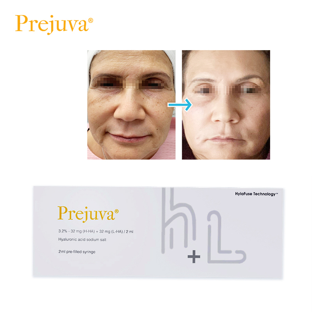 reel fill hyaluronic acid bio-remodelling injections
